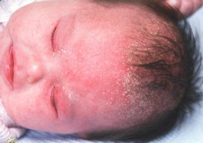  嬰兒脂漏性皮膚炎 ─ 安安兒科衛教單3