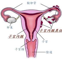 子宮內膜異位症-安安試管嬰兒中心,不孕症,試管嬰兒,人工受孕,冷凍卵子