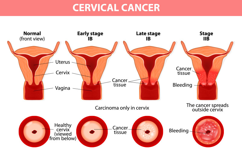 『婦科』認識人類乳突病毒與子宮頸癌